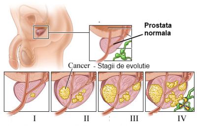 prostata forte