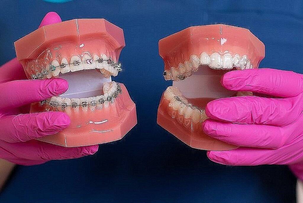 (P) Te gândești să optezi pentru un aparat dentar invizibil? Iată ce trebuie să știi