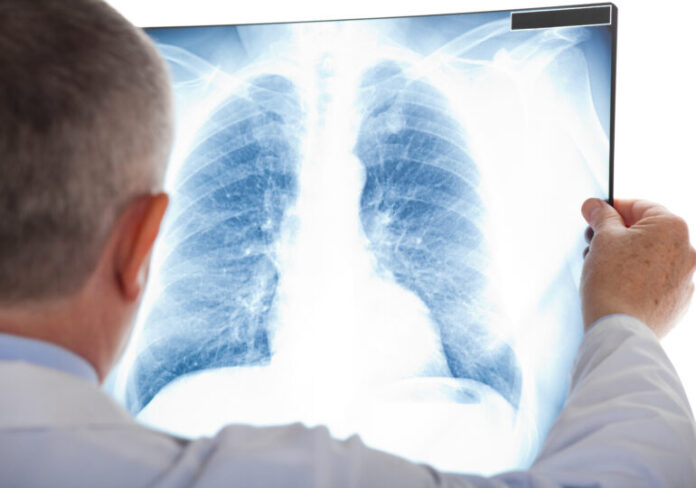 Un gaz aflat în sol duce la creșterea alarmantă a cazurilor de cancer pulmonar