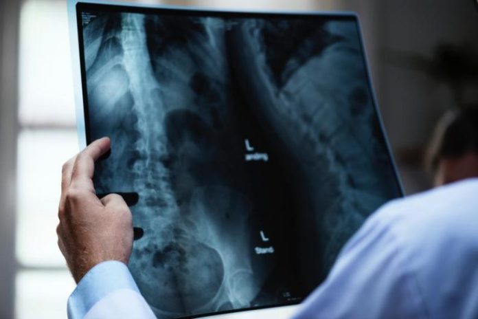 În ajutorul oaselor tale: Cum să previi osteoporoza și să îți întărești sistemul osos