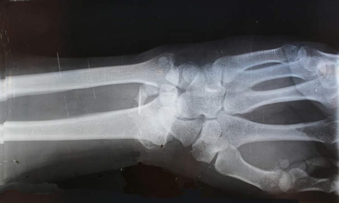 Revoluție în Ortopedie: „Super-Cleiul” care repară oasele rupte în doar 3 minute