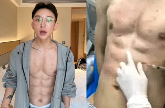 560.000 de dolari cheltuiți pe injecții cu acid hialuronic pentru pătrățele false pe abdomen