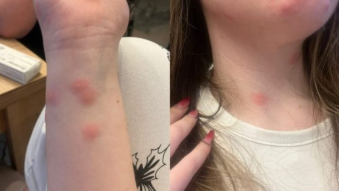 O tânără a ajuns la spital după ce a fost mușcată de ploșnițe într-un tren CFR