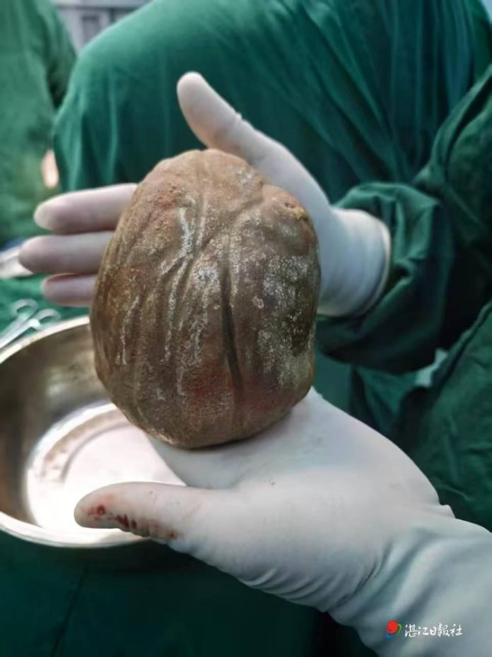Piatră de aproape 1,3 kilograme în vezica urinară